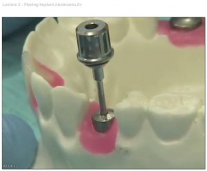 Prosthetic phase